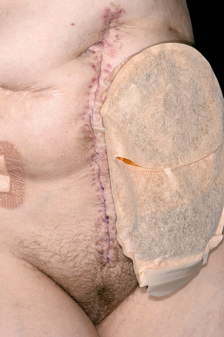 Post pelvic exenteration surgery