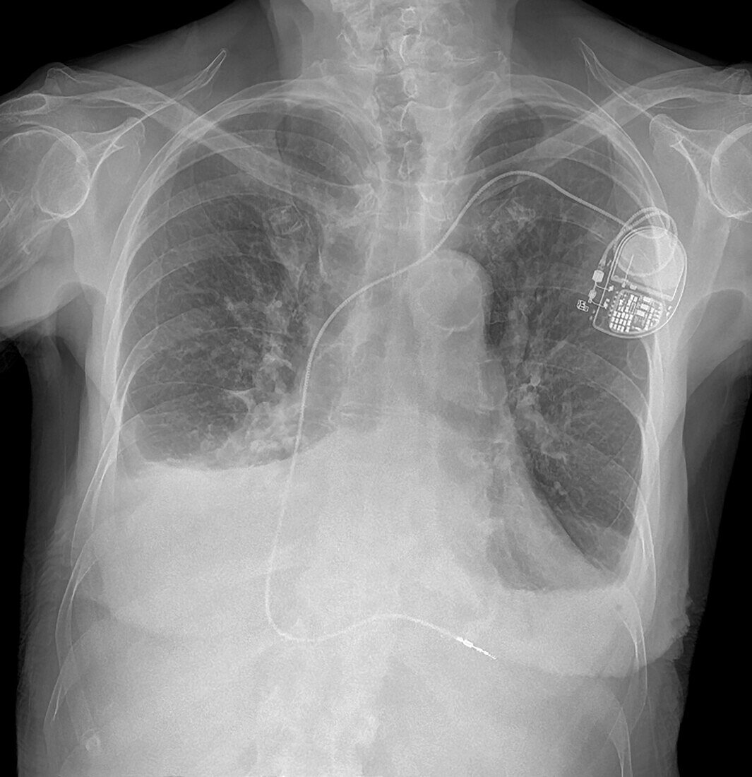 Heart failure, X-ray
