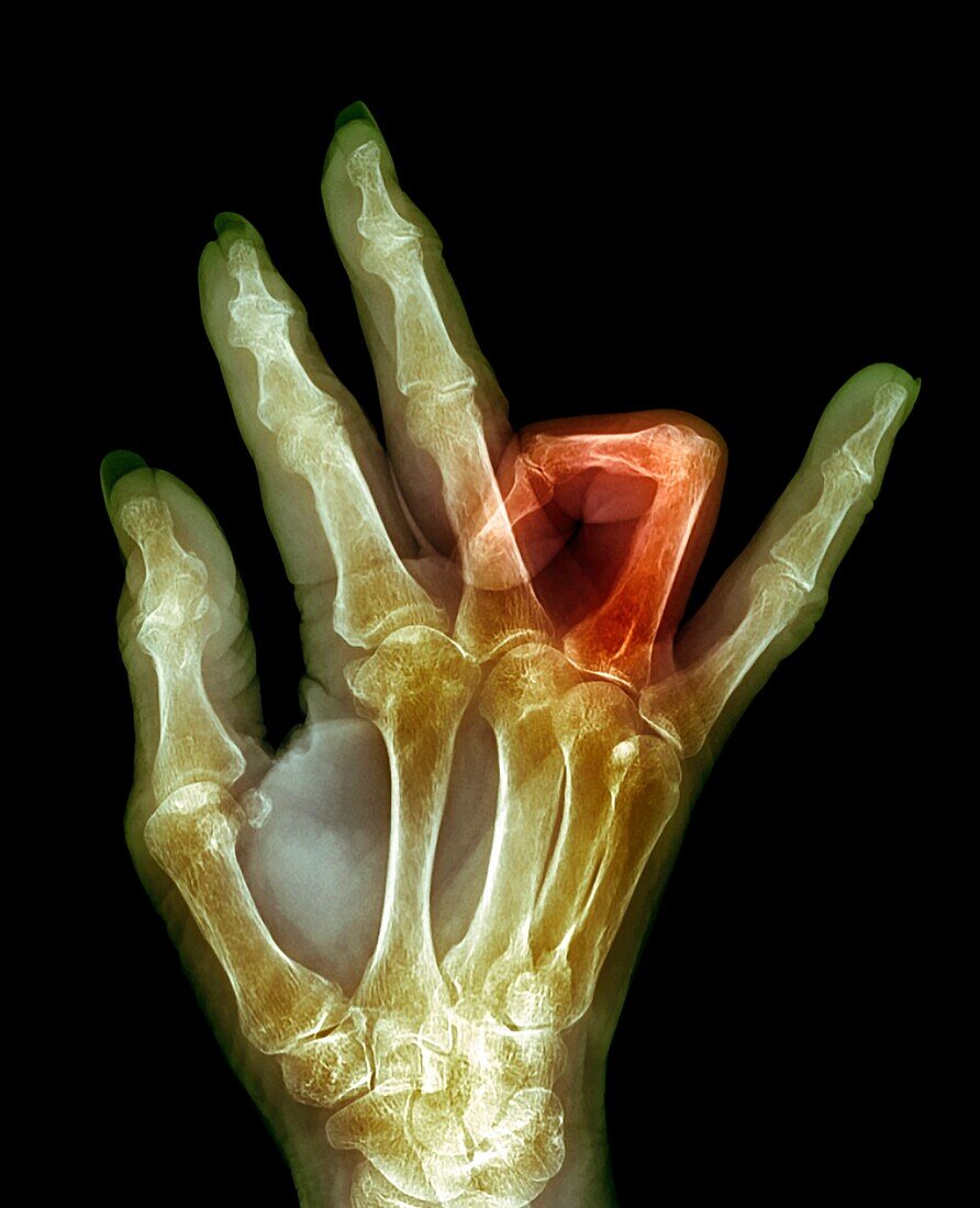 Dupuytren's contracture, X-ray