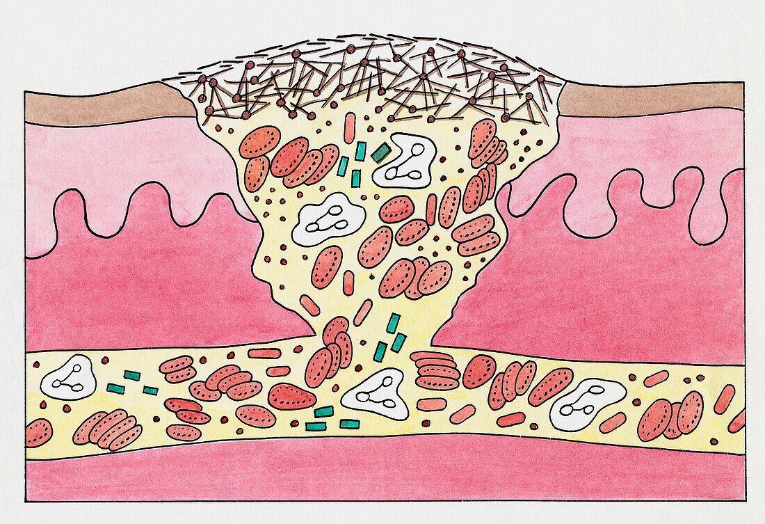 Blood clot formation, illustration