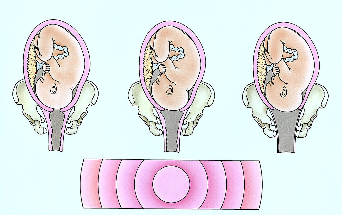 Opening of the cervix, illustration