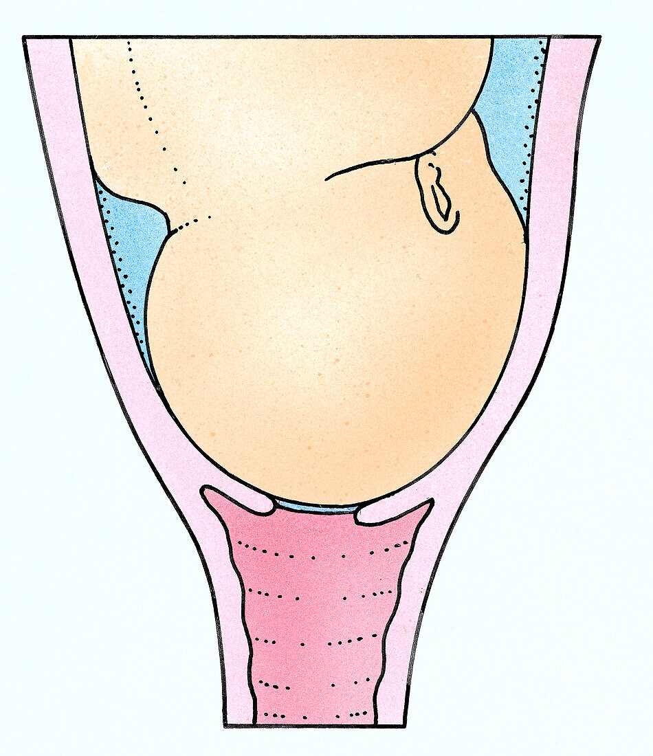 Head of baby resting on a dilating cervix, illustration