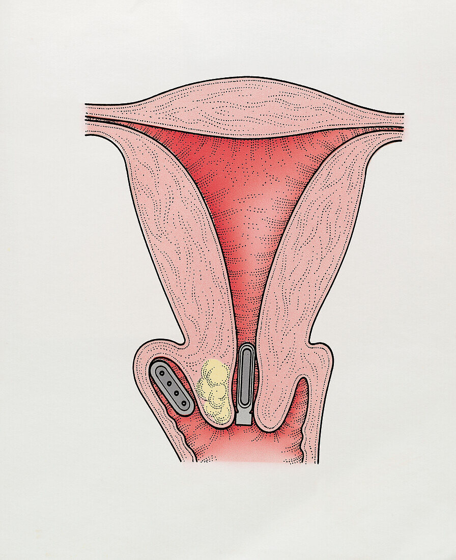 Capsules of radioactive material in vagina, illustration