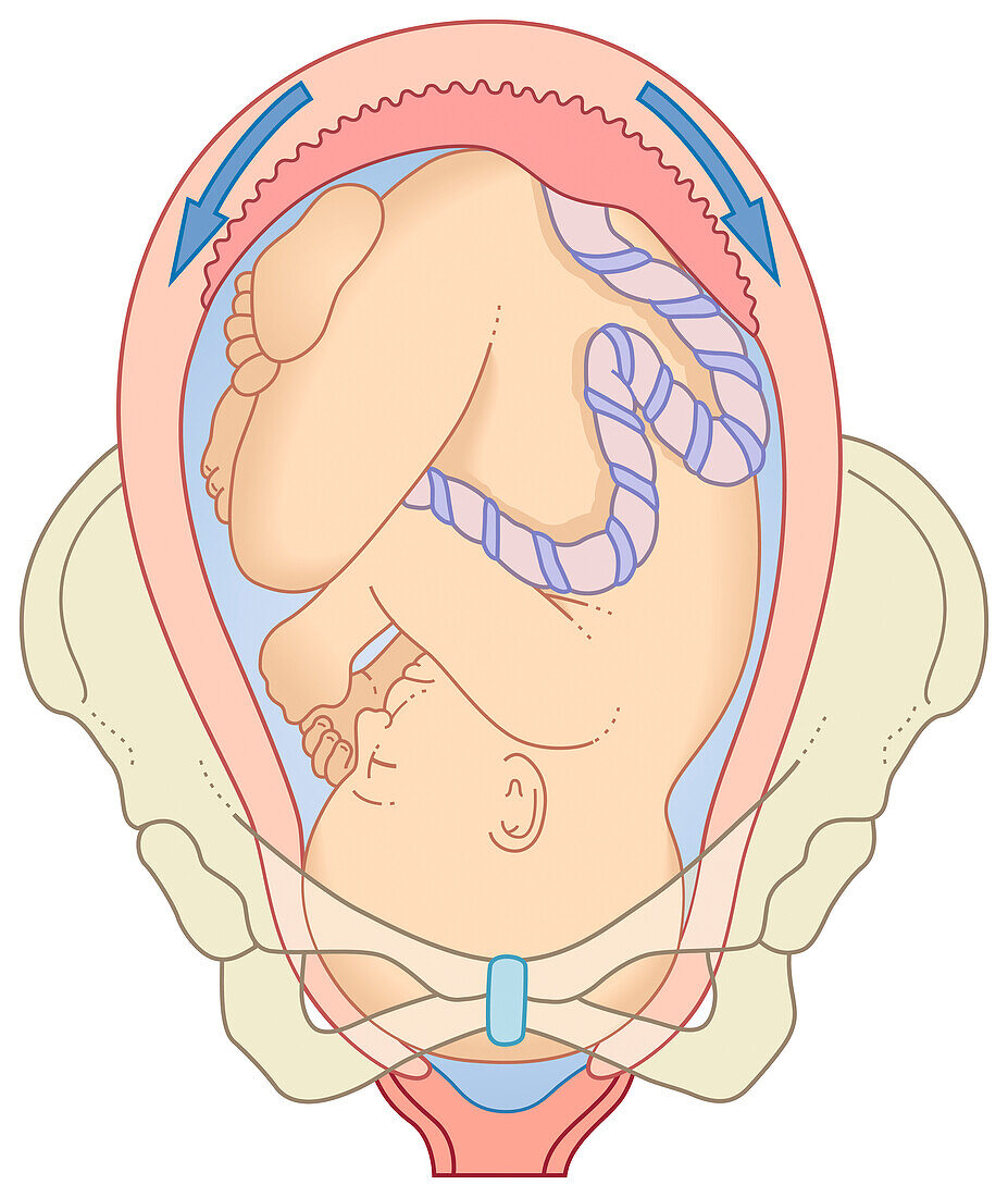 Swollen uterus containing baby facing downward, illustration