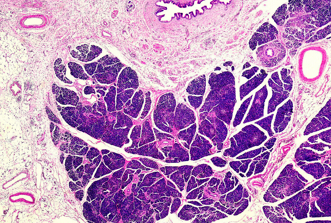 Familial pancreatic cancer, light micrograph