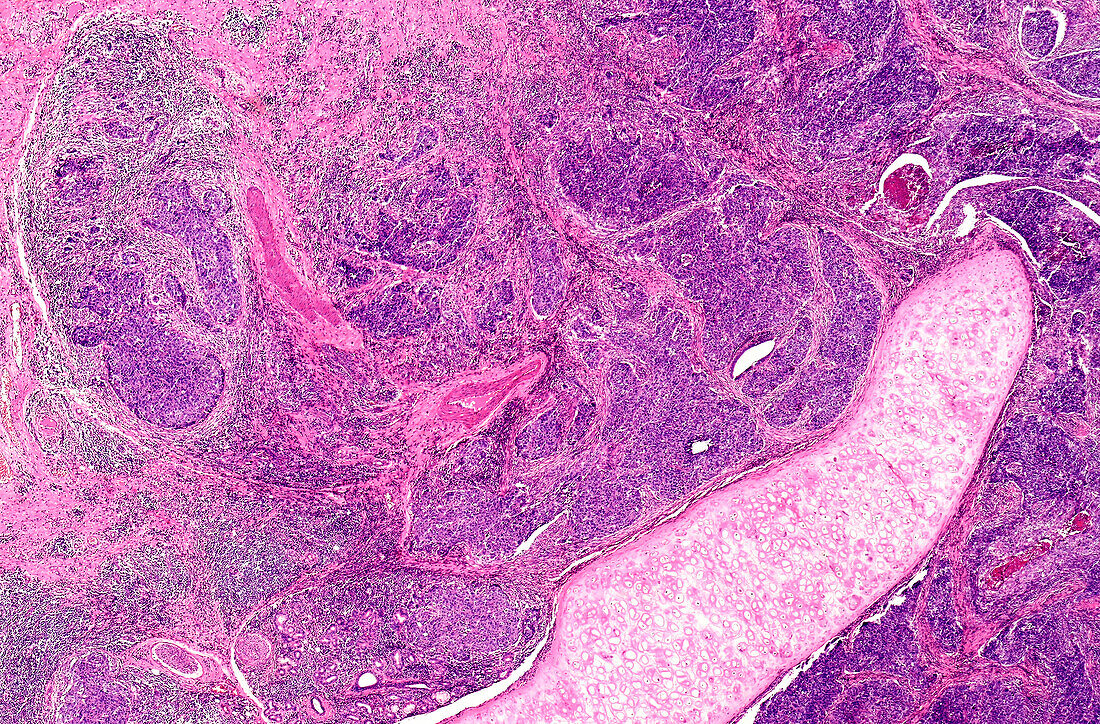 Laryngeal and pharyngeal cancer, light micrograph