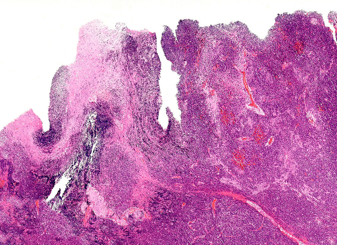 Paediatric medulloblastoma, light micrograph