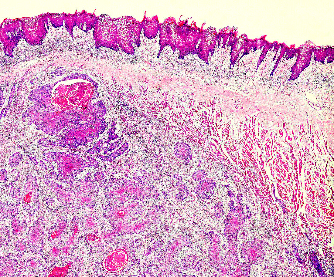 Mouth cancer, light micrograph