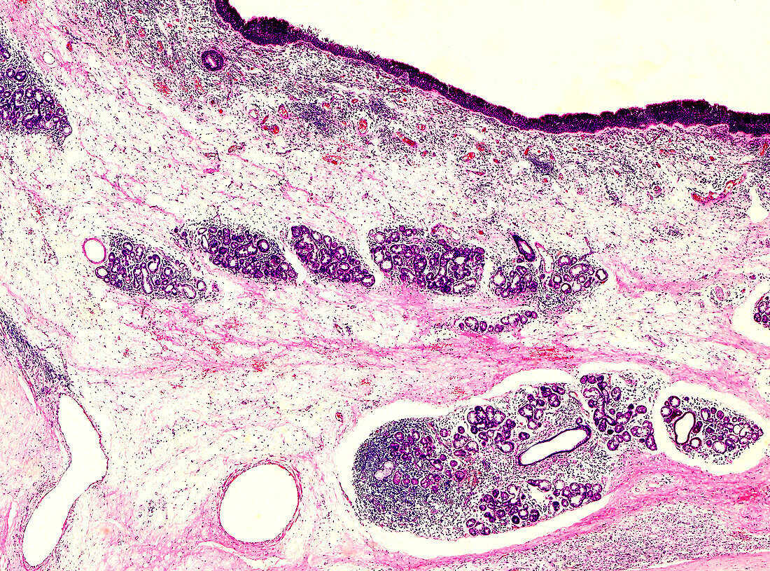 Nasopharyngeal carcinoma, light micrograph