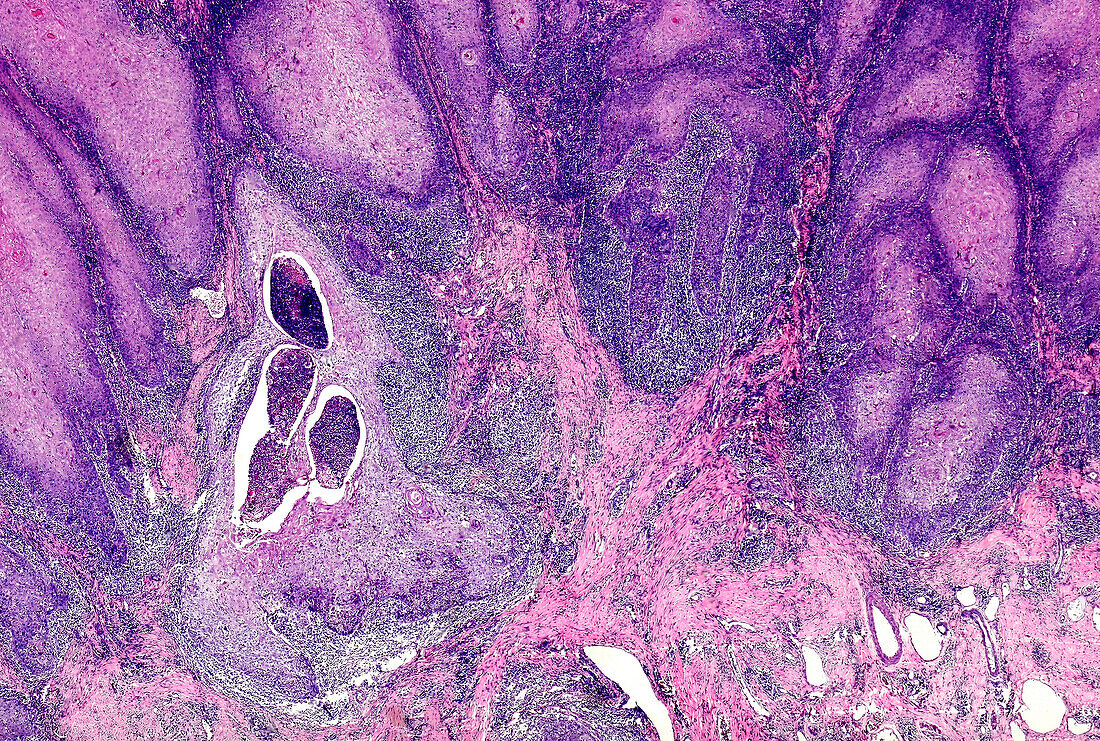 Penile cancer, light micrograph
