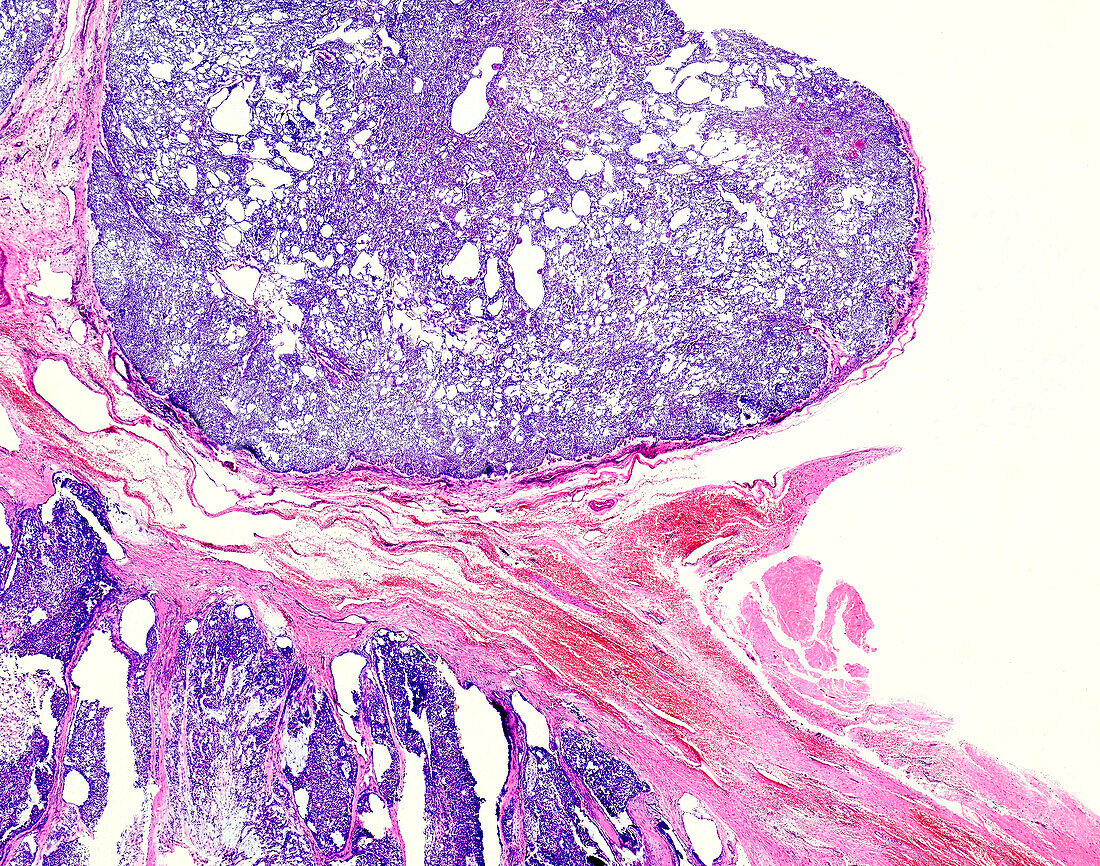 Salivary gland cancer, light micrograph