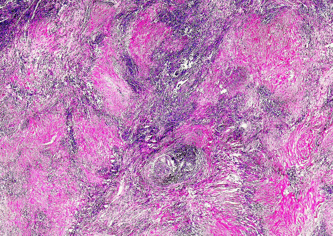 Silicosis of the lung, light micrograph