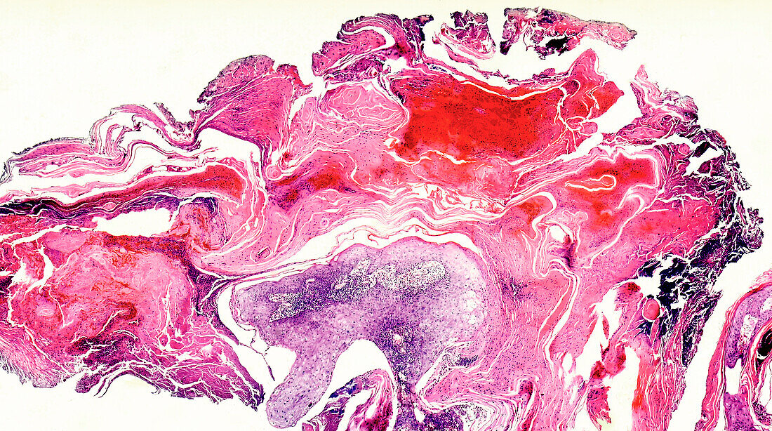 Vulval cancer, light micrograph