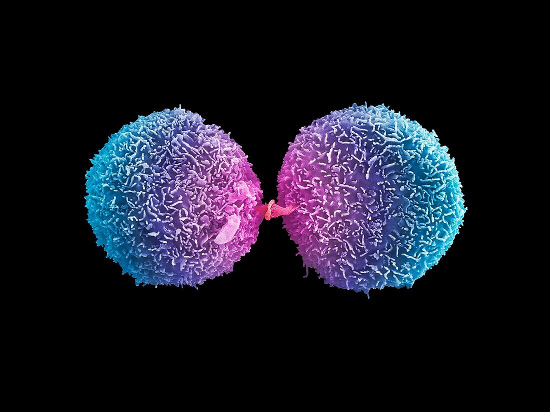 Lung cancer cells dividing, SEM