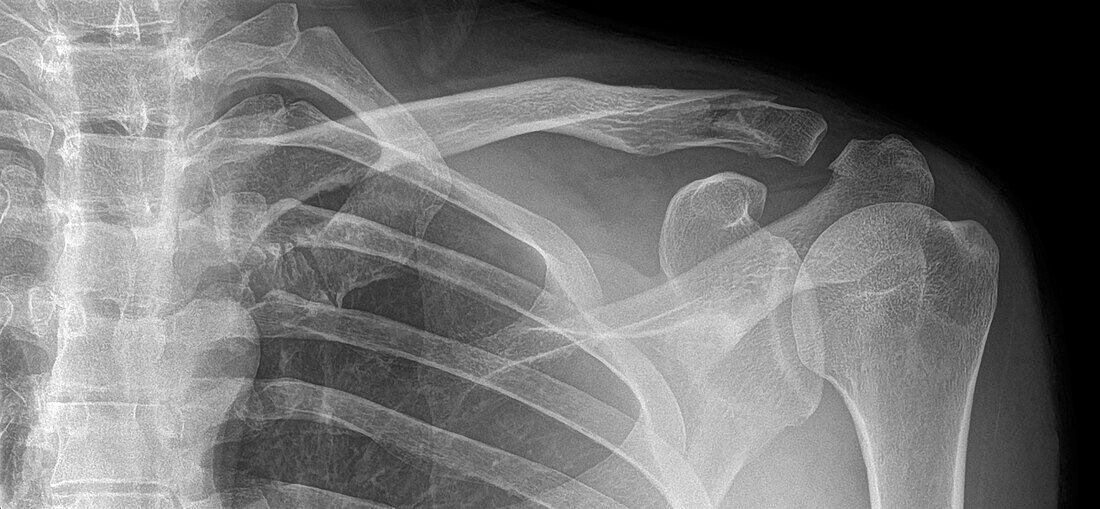 Fractured collar bone, X-ray