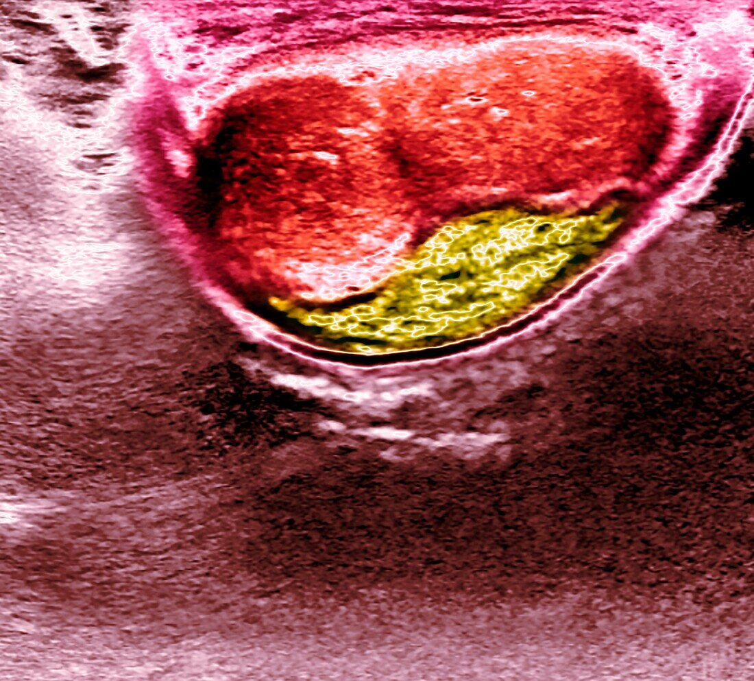 Plaque in a patient with Peyronie's disease, ultrasound scan