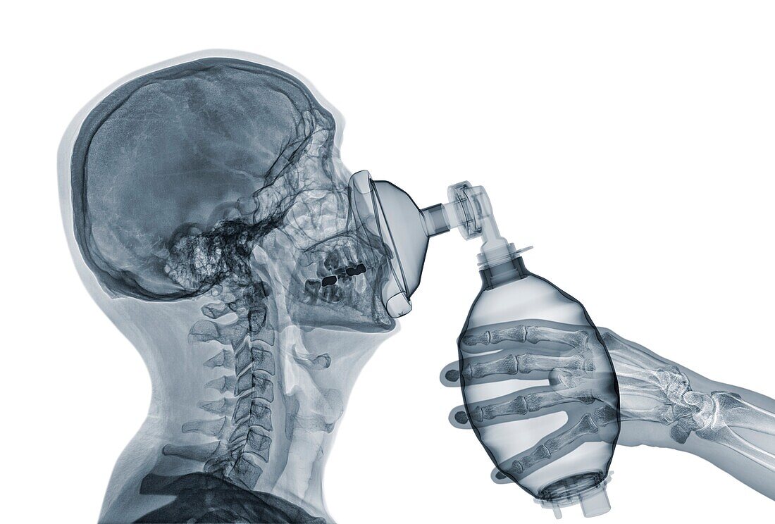 Person with assistant breathing apparatus, X-ray