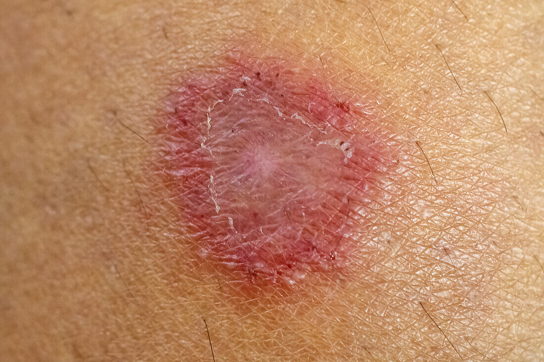 Fungal skin infection