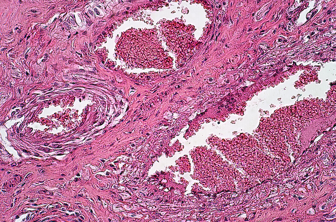 Necrotic oesophagitis, light micrograph