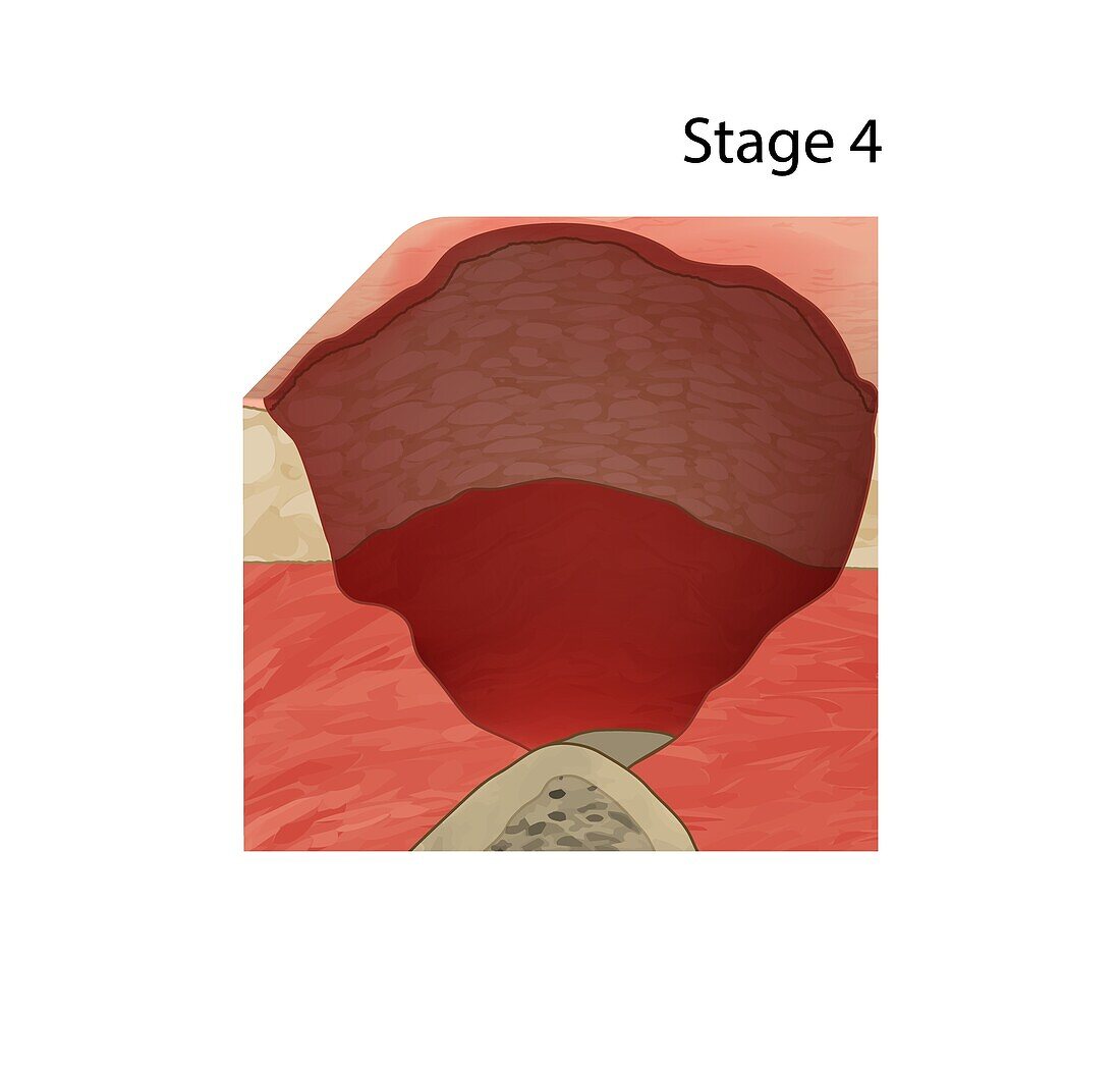 Stage 4 pressure sore, illustration