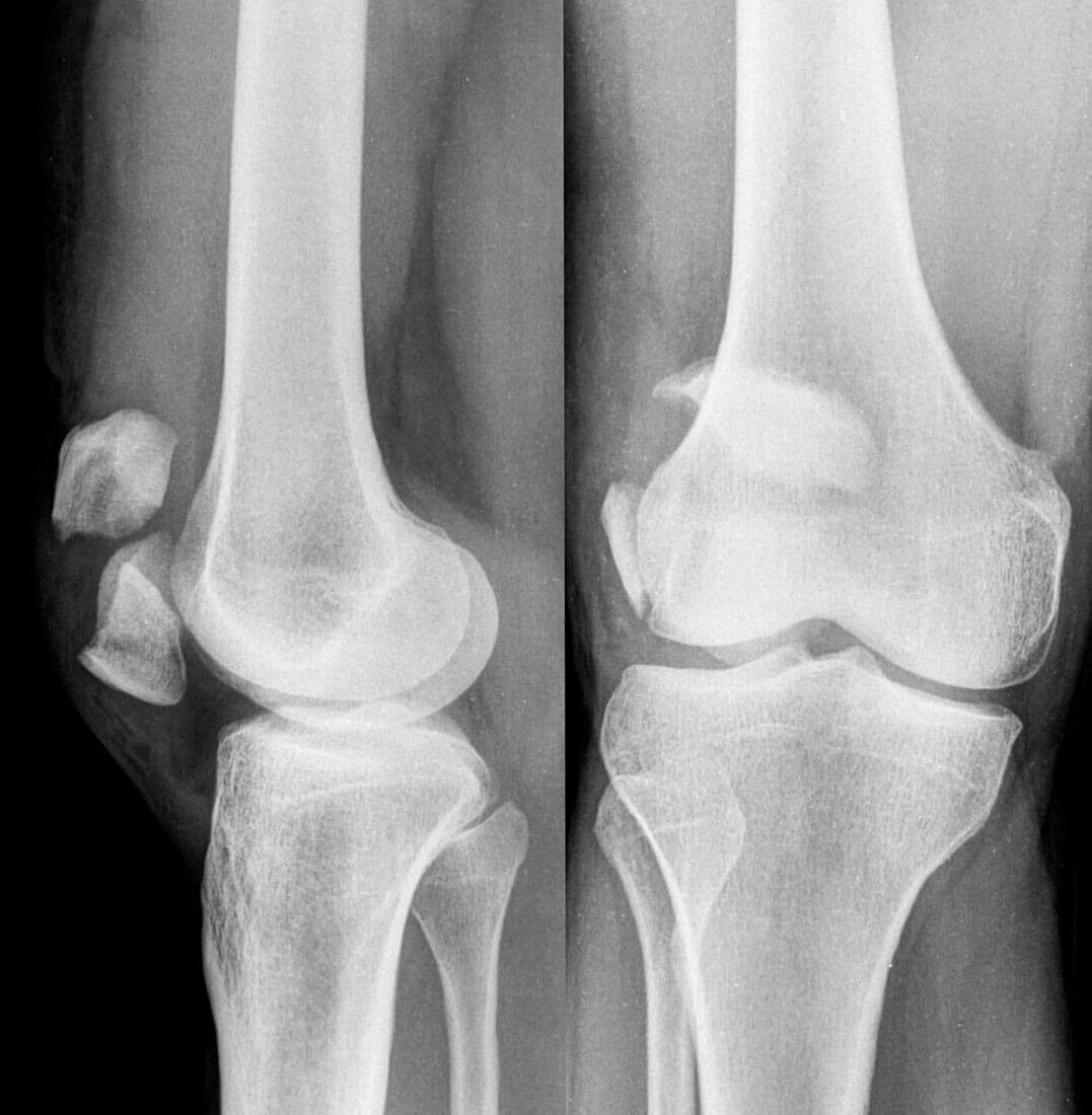 Kneecap fracture, X-ray