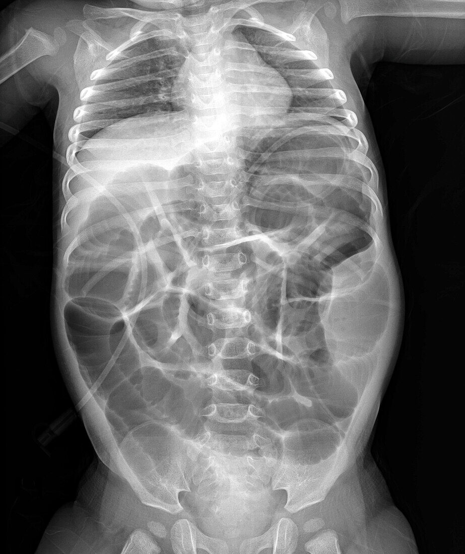 Intussusception of the intestines, X-ray