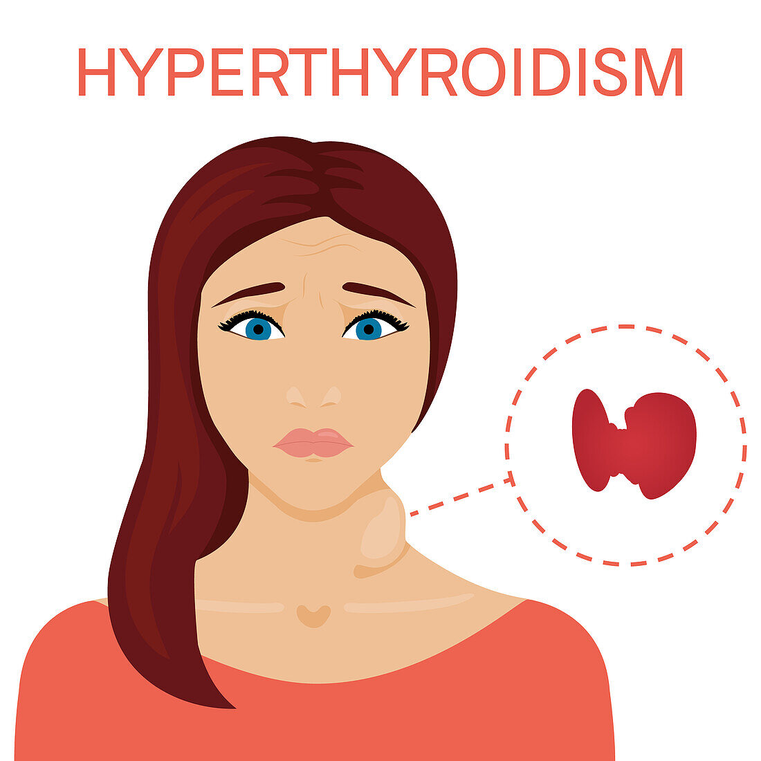 Woman with hyperthyroidism, illustration