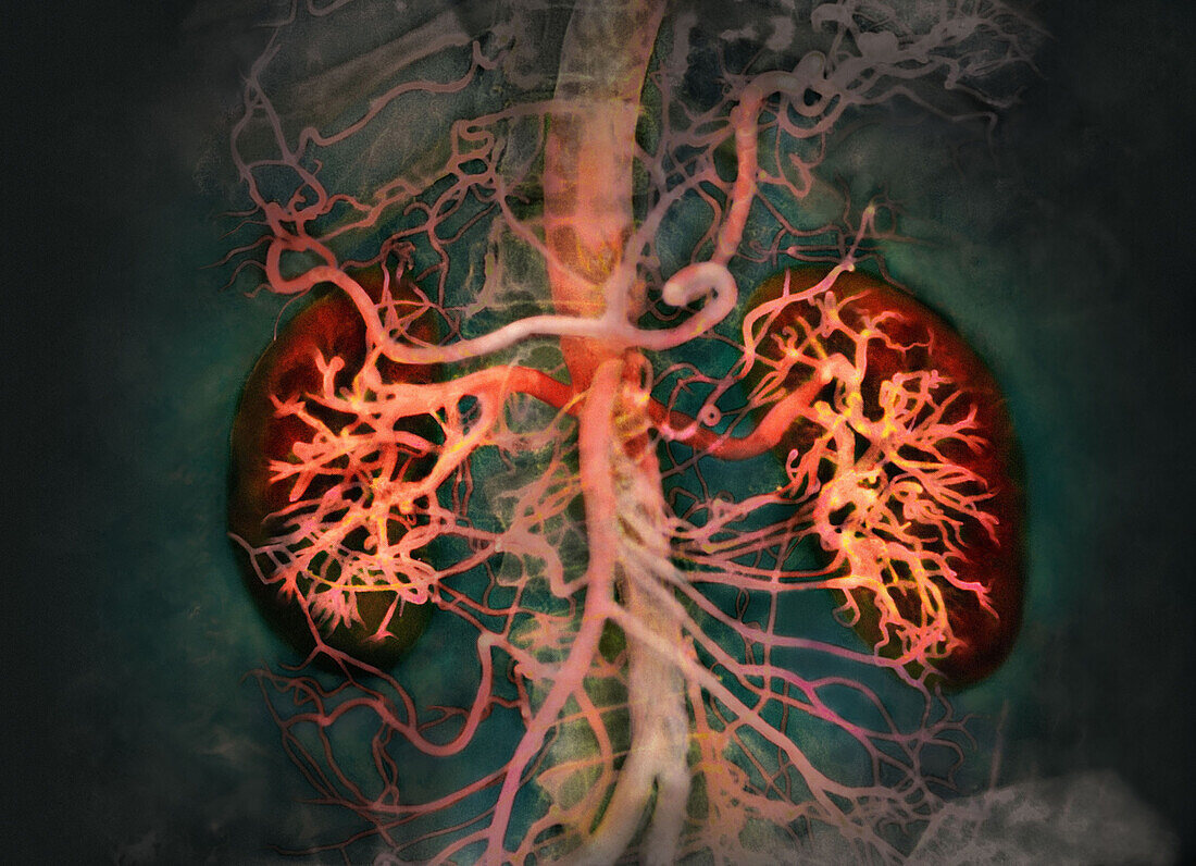 Abdominal Arteries, X-ray