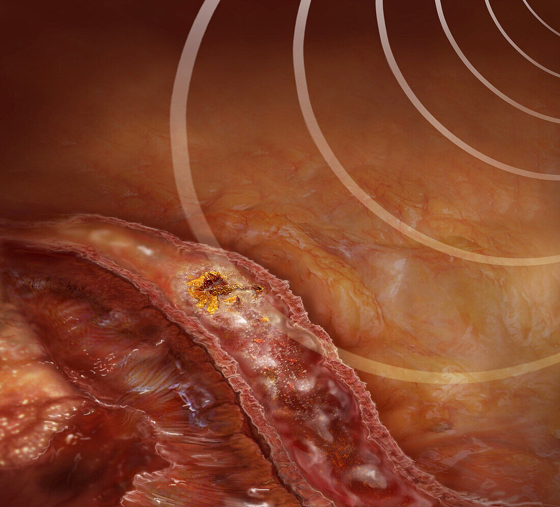 Kidney Stone, Lithotripsy Treatment