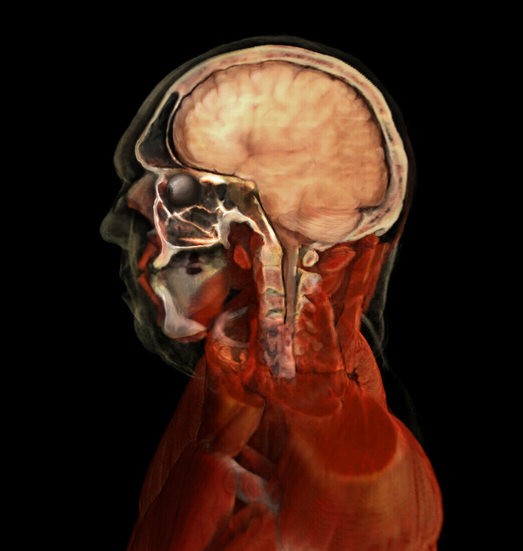 Brain and Nasal Cavity, Male Head