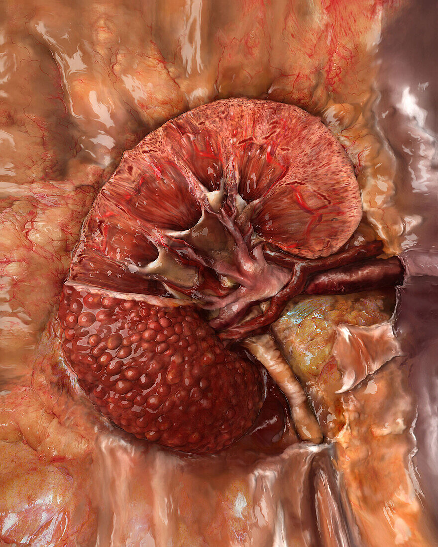 Unhealthy Kidney, Sectioned