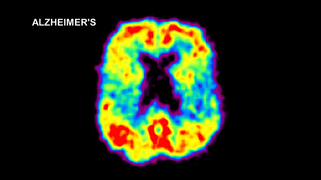 Brain Affected by Alzheimer's Disease, PET Scan