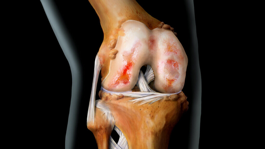 Knee with Advanced Arthritis, 4 of 4