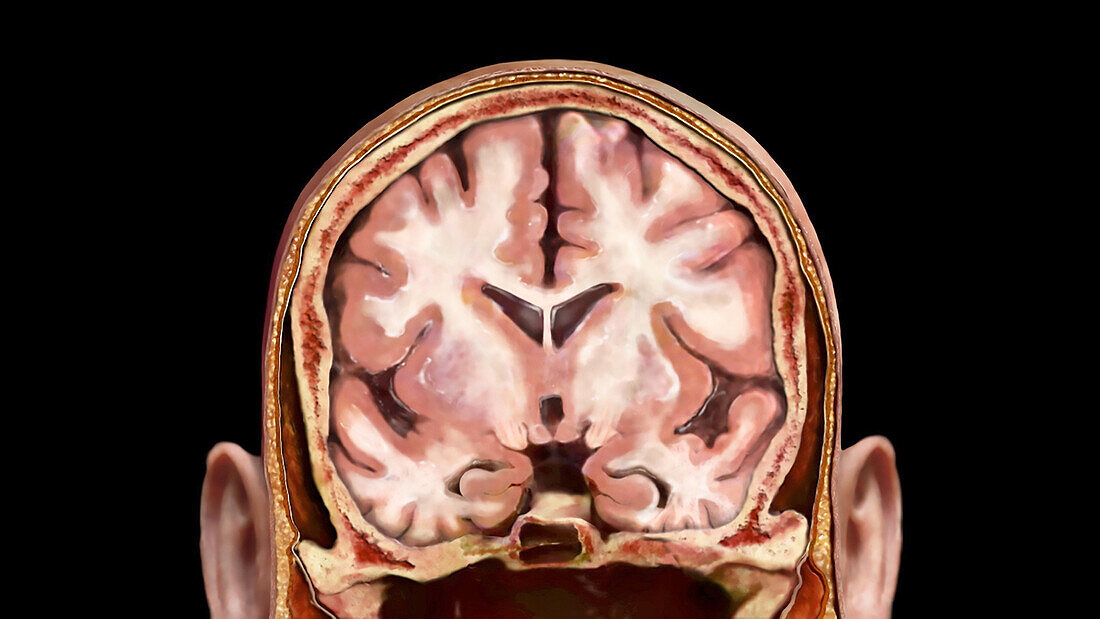 Coronal Section of Brain, Healthy