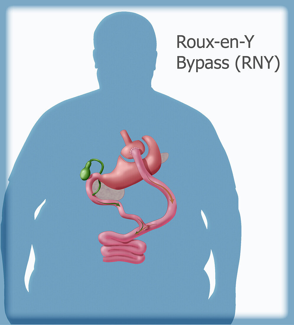 Roux-en-Y Gastric Bypass Surgery