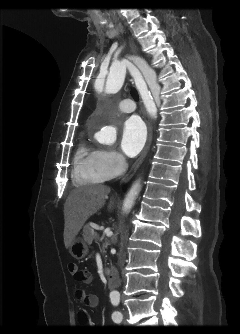 CTA Aortic Dissection