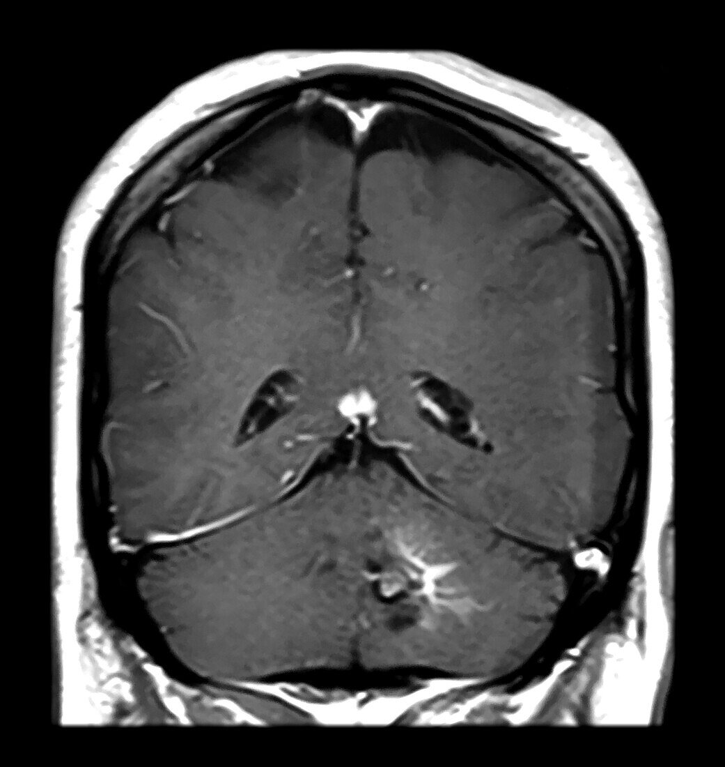 MRI DVA and Cavernous Malformation