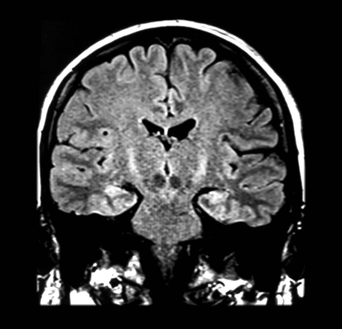 MRI Amyotrophic Lateral Sclerosis (ALS)