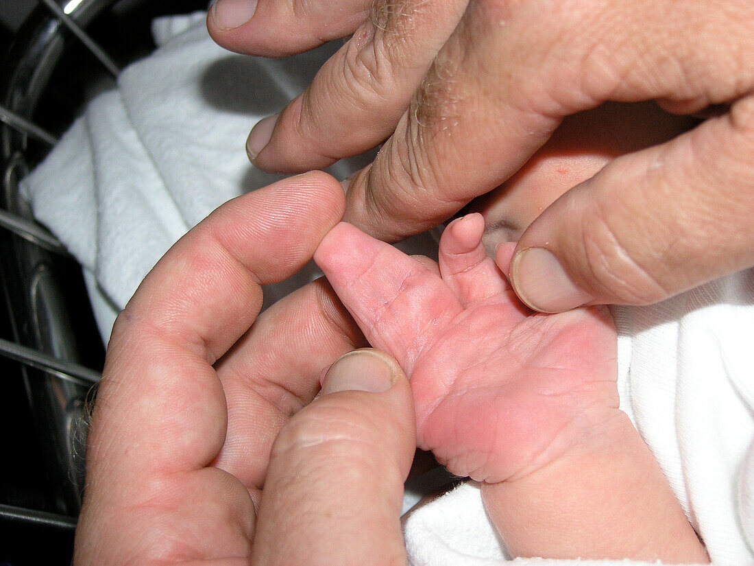 Complex Syndactyly in Newborn