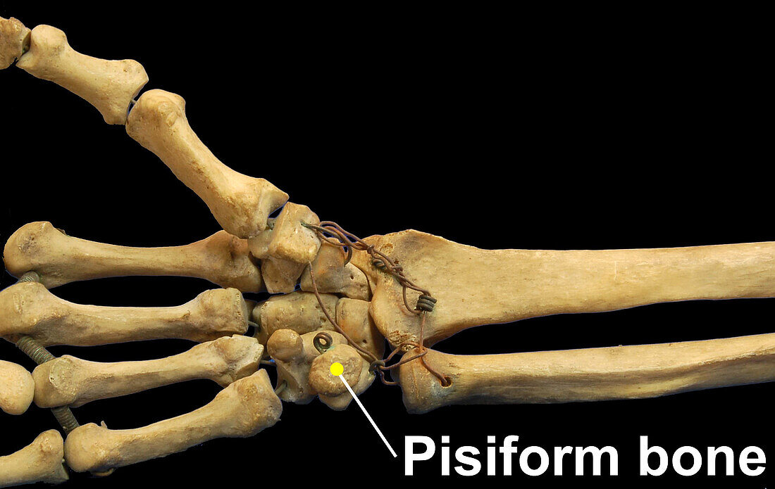 Pisiform Bone