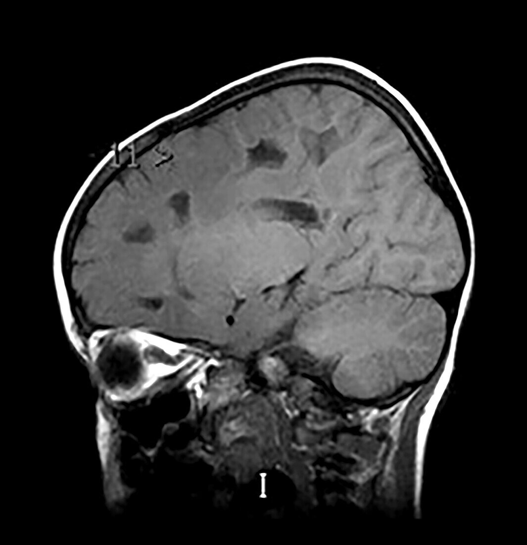 Vanishing White Matter Disease