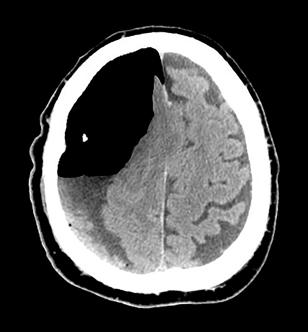 Large Acute on Chronic Subdural Hematoma on CT