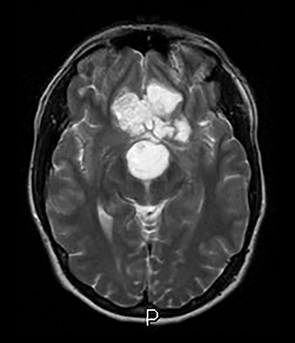 Intracranial Dermoid Cyst On Mri Bild Kaufen 13496154 Science Photo