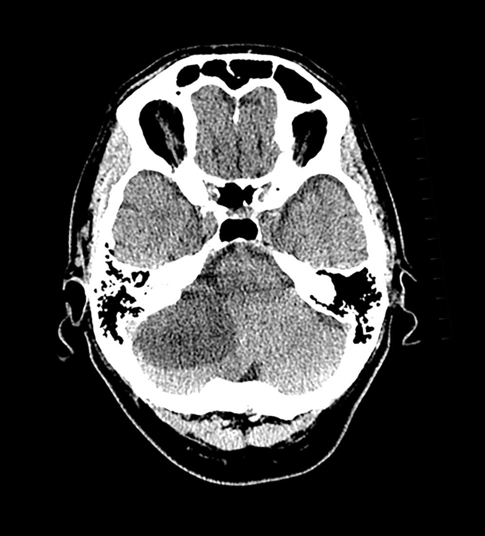 Cerebellar Hemangioblastoma MRI