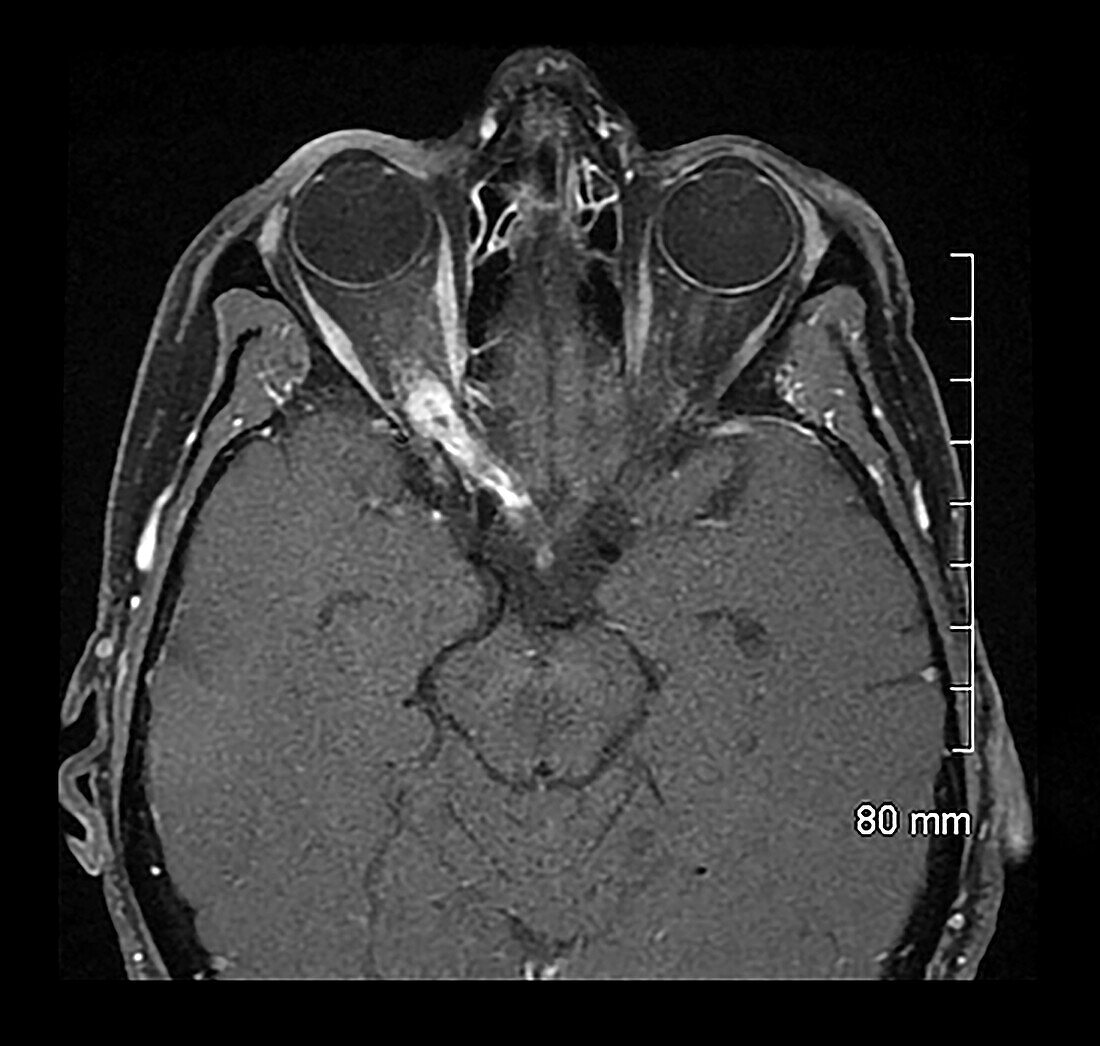 MRI Optic Nerve Glioma in Adult