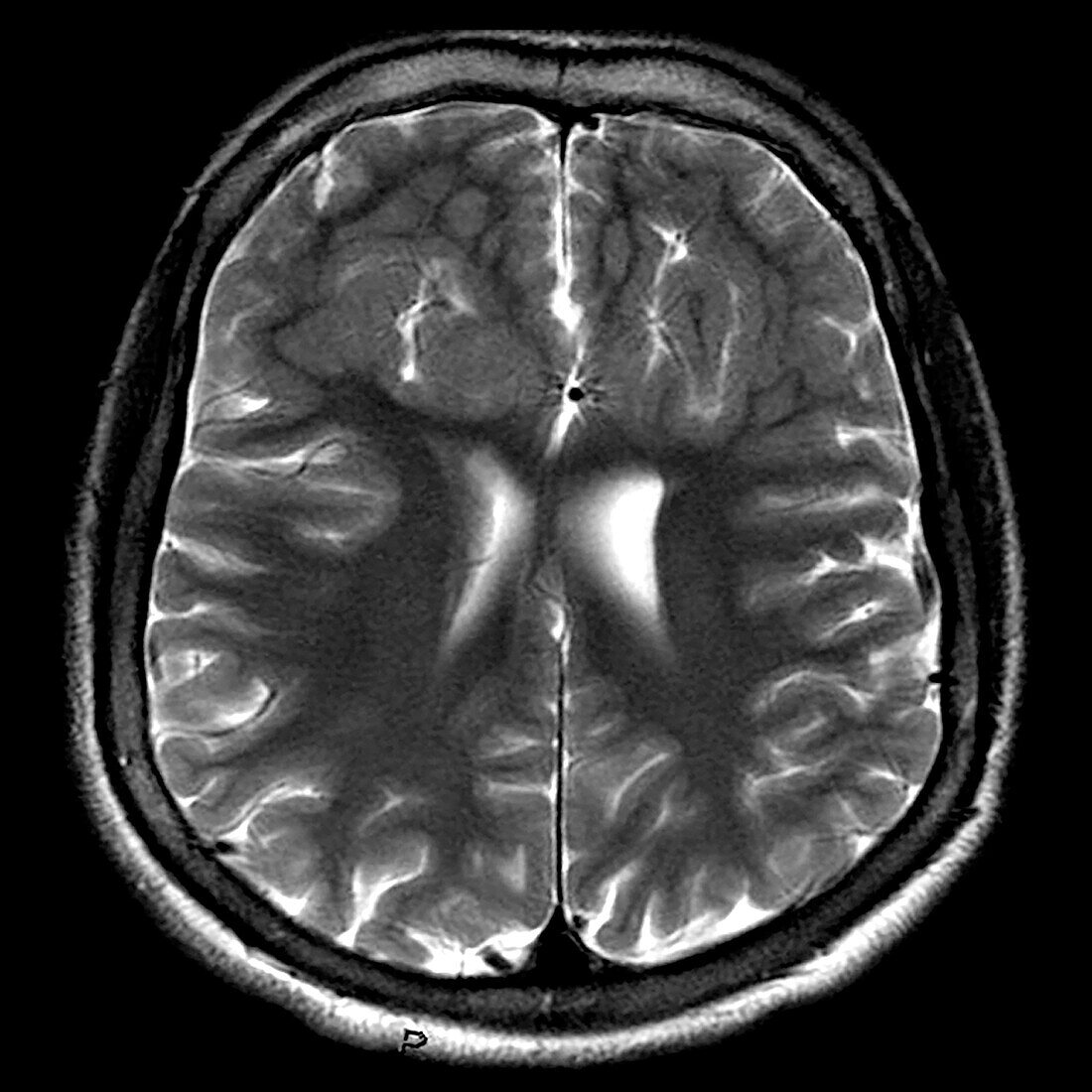 Malformation of Cortical Development MRI