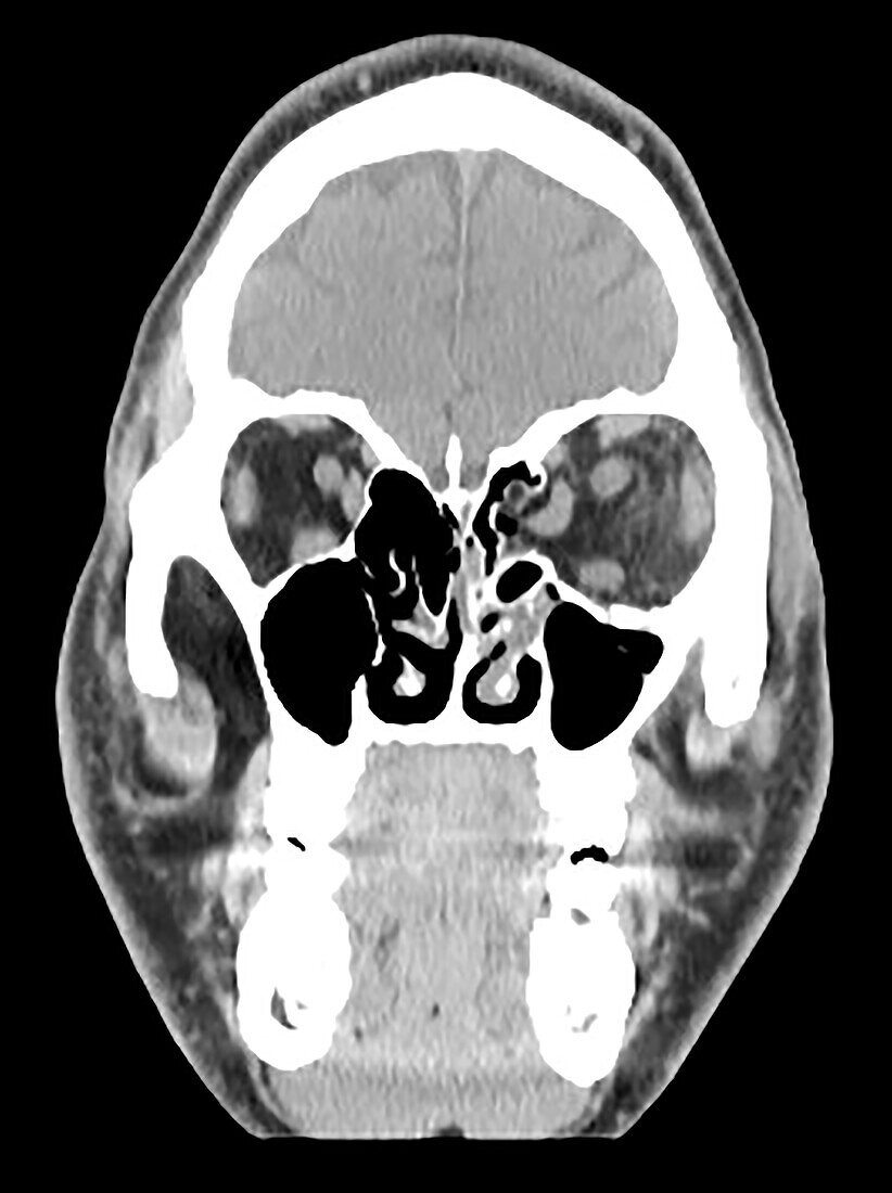 Medial Blowout Fracture of Orbit on CT