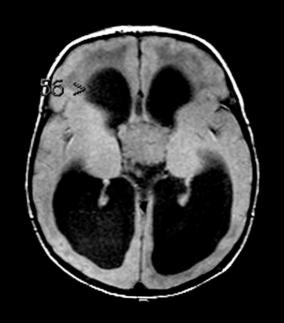 MRI Choroid Plexus Papilloma in Infant