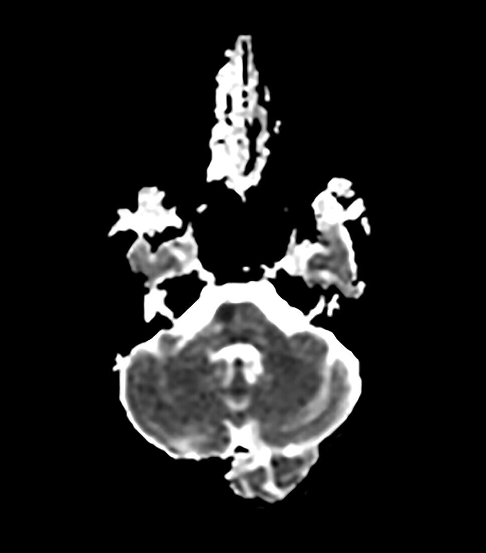 MRI Small Pontine (brainstem) Infarct