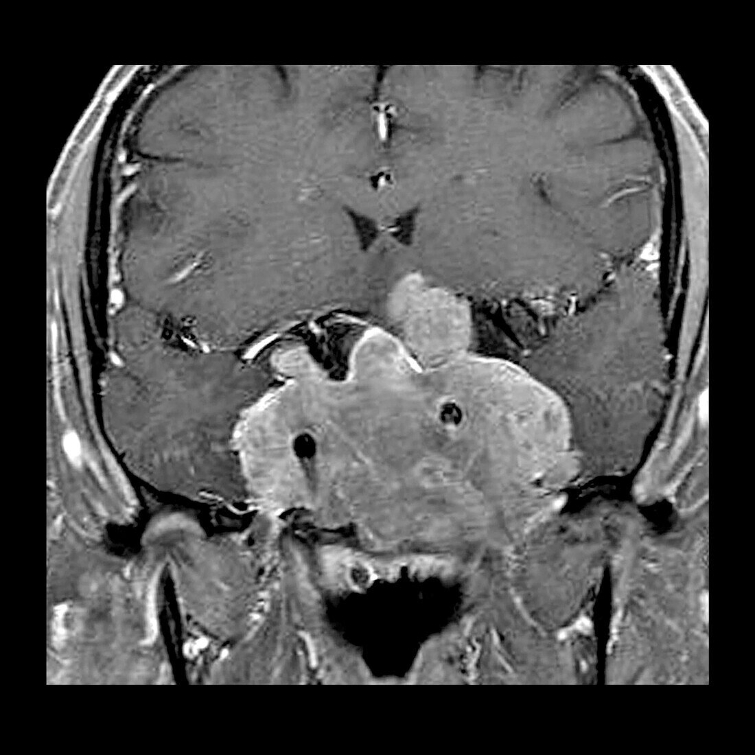 Invasive Pituitary Adenoma on MRI